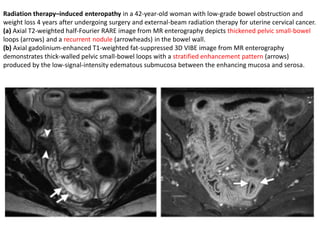 Radiation therapy–induced enteropathy in a 42-year-old woman with low-grade bowel obstruction and 
weight loss 4 years after undergoing surgery and external-beam radiation therapy for uterine cervical cancer. 
(a) Axial T2-weighted half-Fourier RARE image from MR enterography depicts thickened pelvic small-bowel 
loops (arrows) and a recurrent nodule (arrowheads) in the bowel wall. 
(b) Axial gadolinium-enhanced T1-weighted fat-suppressed 3D VIBE image from MR enterography 
demonstrates thick-walled pelvic small-bowel loops with a stratified enhancement pattern (arrows) 
produced by the low-signal-intensity edematous submucosa between the enhancing mucosa and serosa. 
 