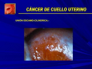 UNIÓN ESCAMO-CILINDRICA.- CÁNCER DE CUELLO UTERINO 