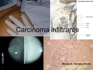 Carcinoma infiltrante Mónica A. Herrera Urbiola 