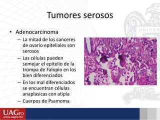 Tumores serosos
• Adenocarcinoma
– La mitad de los canceres
de ovario epiteliales son
serosos
– Las células pueden
semejar el epitelio de la
trompa de Falopio en los
bien diferenciados
– En los mal diferenciados
se encuentran células
anaplasicas con atipia
– Cuerpos de Psamoma
 