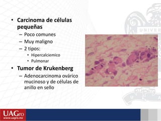 • Carcinoma de células
pequeñas
– Poco comunes
– Muy maligno
– 2 tipos:
• Hipercalciemico
• Pulmonar
• Tumor de Krukenberg
– Adenocarcinoma ovárico
mucinoso y de células de
anillo en sello
 