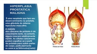 HIPERPLASIA
PROSTÁTICA
MALIGNA
É uma neoplasia que tem seu
desenvolvimento na próstata,
uma glândula do sistema
reprodutor masculino.
A maioria
dos cânceres de próstata é de
crescimento lento, no entanto,
alguns crescem relativamente
rápido. As células cancerosas
podem espalhar-se a partir
da próstata para outras partes
do corpo, particularmente
os ossos e os linfonodos(meta)
 