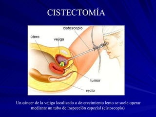 Un cáncer de la vejiga localizado o de crecimiento lento se suele operar mediante un tubo de inspección especial (cistoscopio)  CISTECTOMÍA   
