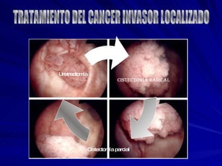 TRATAMIENTO DEL CANCER INVASOR LOCALIZADO Cistectomía radical Cistectomía parcial Uretrectomía 