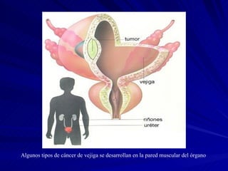 Algunos tipos de cáncer de vejiga se desarrollan en la pared muscular del órgano   
