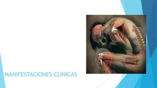 MANIFESTACIONES CLINICAS
 