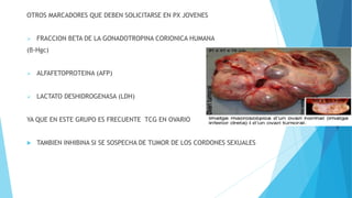 OTROS MARCADORES QUE DEBEN SOLICITARSE EN PX JOVENES
 FRACCION BETA DE LA GONADOTROPINA CORIONICA HUMANA
(β-Hgc)
 ALFAFETOPROTEINA (AFP)
 LACTATO DESHIDROGENASA (LDH)
YA QUE EN ESTE GRUPO ES FRECUENTE TCG EN OVARIO
 TAMBIEN INHIBINA SI SE SOSPECHA DE TUMOR DE LOS CORDONES SEXUALES
 