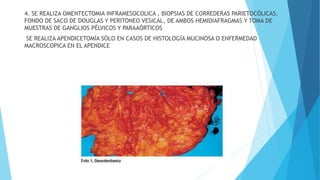 4. SE REALIZA OMENTECTOMIA INFRAMESOCOLICA , BIOPSIAS DE CORREDERAS PARIETOCÓLICAS,
FONDO DE SACO DE DOUGLAS Y PERITONEO VESICAL, DE AMBOS HEMIDIAFRAGMAS Y TOMA DE
MUESTRAS DE GANGLIOS PÉLVICOS Y PARAAÓRTICOS
SE REALIZA APENDICETOMÍA SÓLO EN CASOS DE HISTOLOGÍA MUCINOSA O ENFERMEDAD
MACROSCOPICA EN EL APENDICE
 