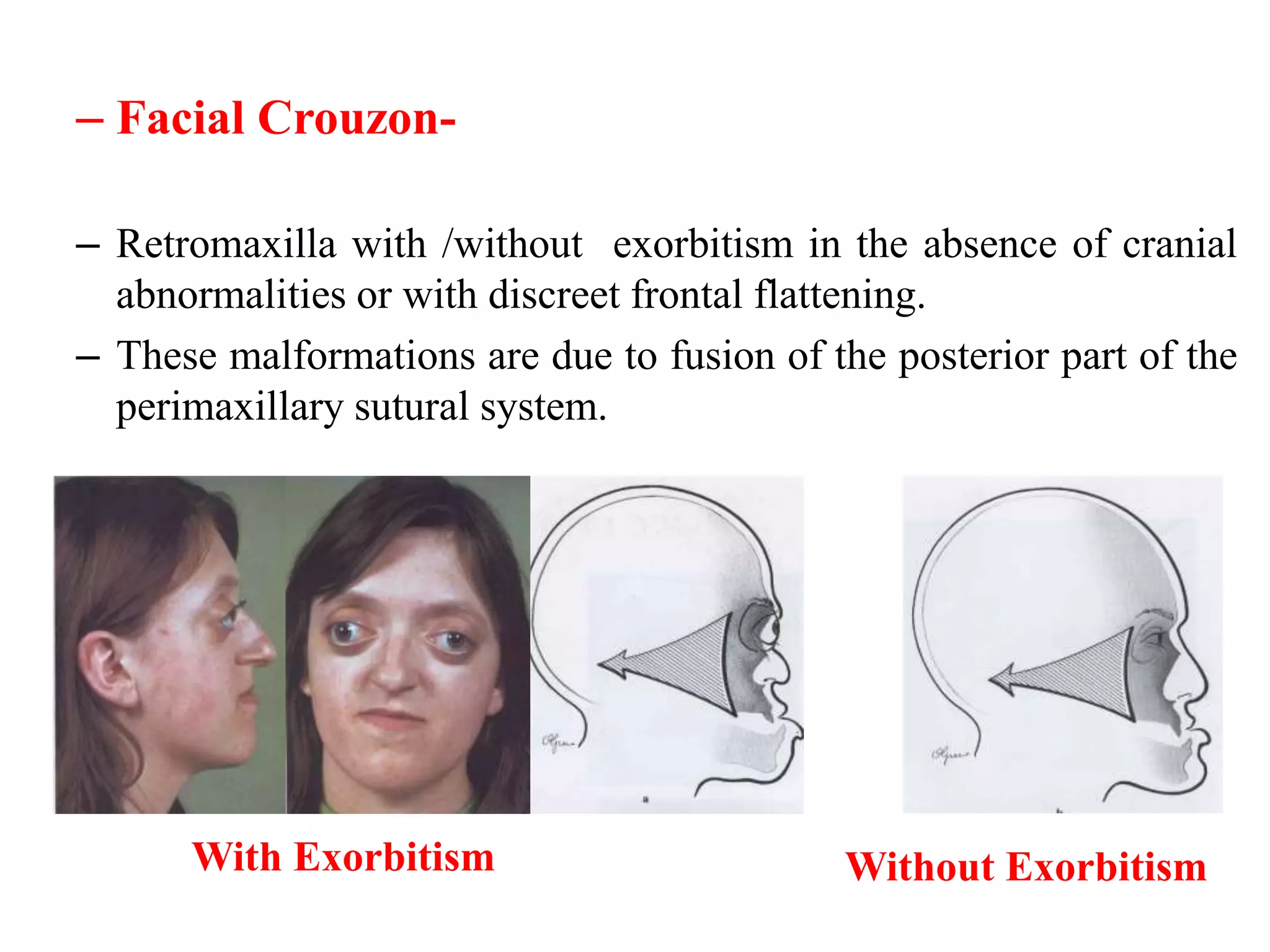 craniofacial anomalies | PPTX