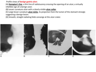 Profile views of benign gastric ulcer. 
(A) Hampton's line, a thin line of radiolucency crossing the opening of an ulcer, a virtually 
infallible sign of a benign ulcer. 
(B) Lesser curvature ulcer with a clearly visible ulcer collar. 
(C) Large lesser curvature ulcer niche, its projection from the lumen of the stomach strongly 
suggesting a benign lesion. 
(D) Smooth, straight radiating folds converge at the ulcer crater. 
 