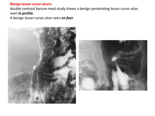 Benign lesser curve ulcers: 
double-contrast barium meal study shows a benign penetrating lesser curve ulcer 
seen in profile. 
A benign lesser curve ulcer seen en face 
 