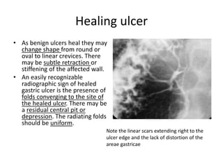 Healing ulcer 
• As benign ulcers heal they may 
change shape from round or 
oval to linear crevices. There 
may be subtle retraction or 
stiffening of the affected wall. 
• An easily recognizable 
radiographic sign of healed 
gastric ulcer is the presence of 
folds converging to the site of 
the healed ulcer. There may be 
a residual central pit or 
depression. The radiating folds 
should be uniform. 
Note the linear scars extending right to the 
ulcer edge and the lack of distortion of the 
areae gastricae 
 
