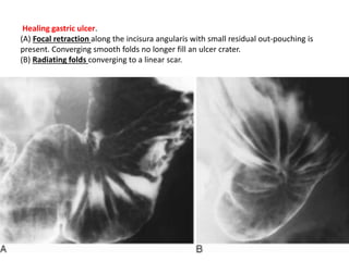 Healing gastric ulcer. 
(A) Focal retraction along the incisura angularis with small residual out-pouching is 
present. Converging smooth folds no longer fill an ulcer crater. 
(B) Radiating folds converging to a linear scar. 
 