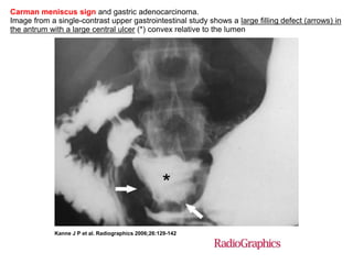 Carman meniscus sign and gastric adenocarcinoma. 
Image from a single-contrast upper gastrointestinal study shows a large filling defect (arrows) in 
the antrum with a large central ulcer (*) convex relative to the lumen 
Kanne J P et al. Radiographics 2006;26:129-142 
 