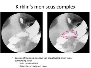 Kirklin’s meniscus complex 
• Consists of Carmen’s meniscus sign plus elevated rim of tumor 
surrounding crater 
• Ulcer - Barium filled 
• Halo - Rim of malignant tissue 
 