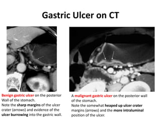Gastric Ulcer on CT 
Benign gastric ulcer on the posterior 
Wall of the stomach. 
Note the sharp margins of the ulcer 
crater (arrows) and evidence of the 
ulcer burrowing into the gastric wall. 
A malignant gastric ulcer on the posterior wall 
of the stomach. 
Note the somewhat heaped up ulcer crater 
margins (arrows) and the more intraluminal 
position of the ulcer. 
 