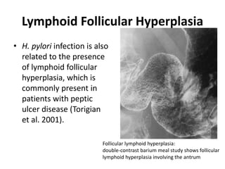 Lymphoid Follicular Hyperplasia 
• H. pylori infection is also 
related to the presence 
of lymphoid follicular 
hyperplasia, which is 
commonly present in 
patients with peptic 
ulcer disease (Torigian 
et al. 2001). 
Follicular lymphoid hyperplasia: 
double-contrast barium meal study shows follicular 
lymphoid hyperplasia involving the antrum 
 