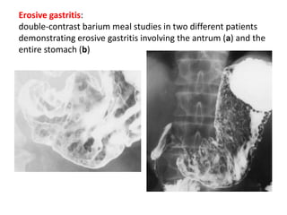 Erosive gastritis: 
double-contrast barium meal studies in two different patients 
demonstrating erosive gastritis involving the antrum (a) and the 
entire stomach (b) 
 