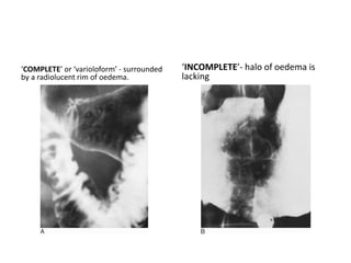 ‘COMPLETE’ or ‘varioloform’ - surrounded 
by a radiolucent rim of oedema. 
‘INCOMPLETE’- halo of oedema is 
lacking 
 