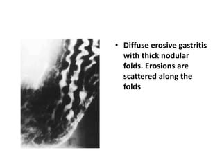 • Diffuse erosive gastritis 
with thick nodular 
folds. Erosions are 
scattered along the 
folds 
 