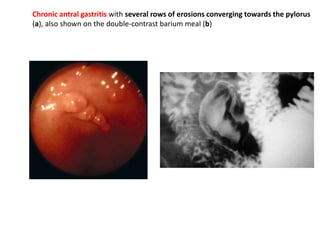 Chronic antral gastritis with several rows of erosions converging towards the pylorus 
(a), also shown on the double-contrast barium meal (b) 
 