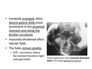 • markedly enlarged, often 
bizarre gastric folds most 
prominent in the proximal 
stomach and along the 
greater curvature. 
• massively thickened often 
lobular folds. 
• The folds remain pliable, 
– D/D - carcinoma, where 
the stomach becomes rigid 
and aperistaltic. Classic appearance with massively distended 
folds in the body sparing the antrum. 
 