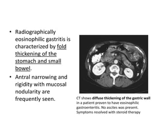 • Radiographically 
eosinophilic gastritis is 
characterized by fold 
thickening of the 
stomach and small 
bowel. 
• Antral narrowing and 
rigidity with mucosal 
nodularity are 
frequently seen. CT shows diffuse thickening of the gastric wall 
in a patient proven to have eosinophilic 
gastroenteritis. No ascites was present. 
Symptoms resolved with steroid therapy 
 