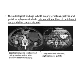 • The radiological findings in both emphysematous gastritis and 
gastric emphysema include thin, curvilinear lines of radiolucent 
gas paralleling the gastric wall. 
Gastric emphysema on abdominal 
radiograph in a patient after 
extensive abdominal surgery. 
Gastric emphysema. 
Note air in the wall of the 
stomach together with much 
gastric residue. The patient was 
vomiting as a result of the tumour 
of the distal stomach, causing 
gastric outlet obstruction 
CT of patient with infectious, 
emphysematous gastritis 
 