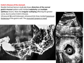 Crohn’s Disease of the stomach. 
Double Contrast barium study (a) shows distortion of the normal 
gastric mucosal pattern with marked nodularity and multiple 
aphthous lesions. Note the irregular scalloping affecting the greater 
curve, due to active Crohn’s Disease. 
Ultrasound (b) and Endoscopic-ultrasound (c) show marked transmural 
thickening of the gastric wall. The muscularis propria is intact 
 