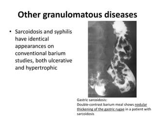 Other granulomatous diseases 
• Sarcoidosis and syphilis 
have identical 
appearances on 
conventional barium 
studies, both ulcerative 
and hypertrophic 
Gastric sarcoidosis: 
Double-contrast barium meal shows nodular 
thickening of the gastric rugae in a patient with 
sarcoidosis 
 