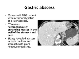 Gastric abscess 
• 65-year-old AIDS patient 
with intramural gastric 
and liver abscess. 
• CT reveals 
heterogeneously 
enhancing masses in the 
wall of the stomach and 
liver . 
• Biopsy revealed abscess 
in both the liver and 
stomach with gram 
negative organisms. 
 