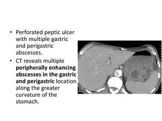 • Perforated peptic ulcer 
with multiple gastric 
and perigastric 
abscesses. 
• CT reveals multiple 
peripherally enhancing 
abscesses in the gastric 
and perigastric location 
along the greater 
curvature of the 
stomach. 
 
