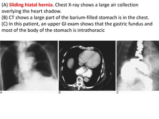 (A) Sliding hiatal hernia. Chest X-ray shows a large air collection 
overlying the heart shadow. 
(B) CT shows a large part of the barium-filled stomach is in the chest. 
(C) In this patient, an upper GI exam shows that the gastric fundus and 
most of the body of the stomach is intrathoracic 
 