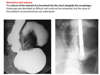 Mesentero-axial volvulus 
The antrum of the stomach has herniated into the chest alongside the oesophagus. 
Endoscopy was described as difficult and could not be completed, but the cause of 
the problems encountered was not understood 
 