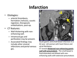 Infarction 
• Etiologies: 
– arterial thrombosis, 
herniation /volvulus, caustic 
ingestion, therapeutic 
embolizations, post-op. 
• CT features: 
– Wall thickening with non-enhancing 
wall. 
– Intramural gas and 
perforation may be present. 
– Associated findings may 
include other visceral 
infarctions and portal venous 
gas. 
Acute gastric and small bowel infarction in a 
62-year -old woman with heart failure and 
atrial fibrillation. 
CT reveals thickened non-enhancing gastric 
wall with pneumatosis . The small bowel is 
fluid distended and dilated with non-enhancing 
walls with extensive pneumatosis 
 