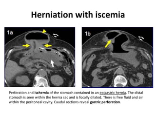 Herniation with iscemia 
Perforation and ischemia of the stomach contained in an epigastric hernia. The distal 
stomach is seen within the hernia sac and is focally dilated. There is free fluid and air 
within the peritoneal cavity. Caudal sections reveal gastric perforation. 
 