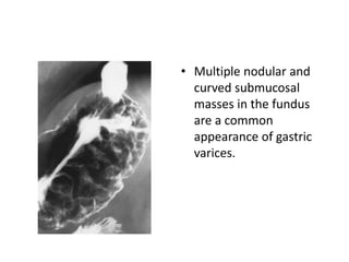 • Multiple nodular and 
curved submucosal 
masses in the fundus 
are a common 
appearance of gastric 
varices. 
 