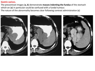 Gastric varices. 
The precontrast images (a, b) demonstrate masses indenting the fundus of the stomach 
which on (a) in particular could be confused with a fundal tumour. 
The nature of the abnormality becomes clear following contrast administration (c) 
 