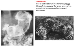 Trichobezoar: 
double-contrast barium meal showing a large 
filling defect occupying the whole lumen of the 
stomach and photograph of the removed 
trichobezoar 
 