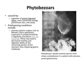 Phytobezoars 
• caused by: 
– ingestion of poorly digested 
fibres, most commonly orange, 
persimmon skin, and seeds. 
• Predisposing conditions 
include: 
– previous gastric surgery such as 
Billroth I and II operations, 
especially if complemented by 
a vagotomy procedure (Szemes and 
Amberg 1968). These may lead to 
decreased motility and 
digestive ability of the 
remaining portion of the 
stomach, thus impairing gastric 
emptying. 
Phytobezoar: double-contrast barium meal 
shows a phytobezoar in a patient with previous 
partial gastrectomy 
 
