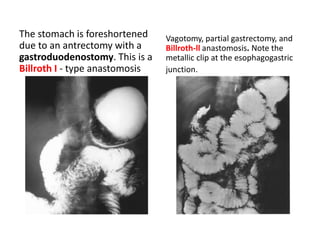 The stomach is foreshortened 
due to an antrectomy with a 
gastroduodenostomy. This is a 
Billroth I - type anastomosis 
Vagotomy, partial gastrectomy, and 
Billroth-ll anastomosis. Note the 
metallic clip at the esophagogastric 
junction. 
 