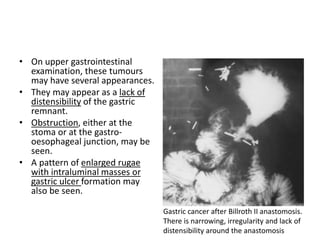 • On upper gastrointestinal 
examination, these tumours 
may have several appearances. 
• They may appear as a lack of 
distensibility of the gastric 
remnant. 
• Obstruction, either at the 
stoma or at the gastro-oesophageal 
junction, may be 
seen. 
• A pattern of enlarged rugae 
with intraluminal masses or 
gastric ulcer formation may 
also be seen. 
Gastric cancer after Billroth II anastomosis. 
There is narrowing, irregularity and lack of 
distensibility around the anastomosis 
 