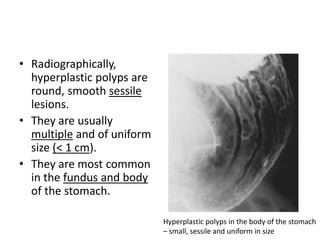 • Radiographically, 
hyperplastic polyps are 
round, smooth sessile 
lesions. 
• They are usually 
multiple and of uniform 
size (< 1 cm). 
• They are most common 
in the fundus and body 
of the stomach. 
Hyperplastic polyps in the body of the stomach 
– small, sessile and uniform in size 
 