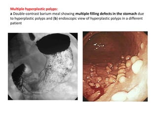 Multiple hyperplastic polyps: 
a Double-contrast barium meal showing multiple filling defects in the stomach due 
to hyperplastic polyps and (b) endoscopic view of hyperplastic polyps in a different 
patient 
 