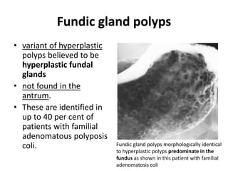 Fundic gland polyps 
• variant of hyperplastic 
polyps believed to be 
hyperplastic fundal 
glands 
• not found in the 
antrum. 
• These are identified in 
up to 40 per cent of 
patients with familial 
adenomatous polyposis 
coli. Fundic gland polyps morphologically identical 
to hyperplastic polyps predominate in the 
fundus as shown in this patient with familial 
adenomatosis coli 
 