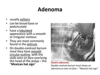 Adenoma 
• usually solitary 
• can be broad base or 
pedunculate 
• have a lobulated 
appearance with a smooth 
or irregular contour. 
• They are most commonly 
found in the antrum. 
• On double-contrast barium 
meal they have smooth 
circular outline, with the 
stalk seen en face overlying 
the head of the polyp – the 
“Mexican hat sign” 
Gastric adenoma: 
Double-contrast barium meal shows an 
adenoma as seen en face – “Mexican hat sign” 
 