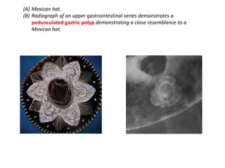 (A) Mexican hat. 
(B) Radiograph of an upper gastrointestinal series demonstrates a 
pedunculated gastric polyp demonstrating a close resemblance to a 
Mexican hat. 
 