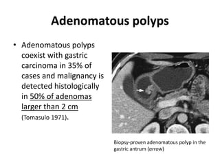 Adenomatous polyps 
• Adenomatous polyps 
coexist with gastric 
carcinoma in 35% of 
cases and malignancy is 
detected histologically 
in 50% of adenomas 
larger than 2 cm 
(Tomasulo 1971). 
Biopsy-proven adenomatous polyp in the 
gastric antrum (arrow) 
 
