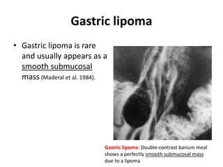 Gastric lipoma 
• Gastric lipoma is rare 
and usually appears as a 
smooth submucosal 
mass (Maderal et al. 1984). 
Gastric lipoma: Double-contrast barium meal 
shows a perfectly smooth submucosal mass 
due to a lipoma 
 