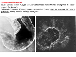 Leiomyoma of the stomach. 
Double Contrast barium study (a) shows a well delineated smooth mass arising from the lesser 
curve of the stomach. 
Endoscopic-ultrasound (b) demonstrates a massive lesion which does not penetrate through the 
gastric wall. Biopsy revealed a benign leiomyoma 
 